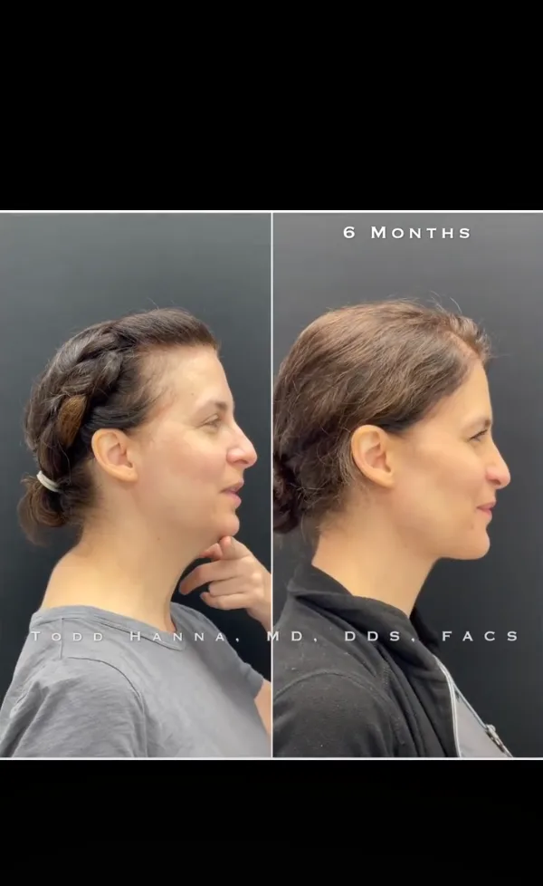 Double Jaw Surgery by Dr Todd Hanna NYC