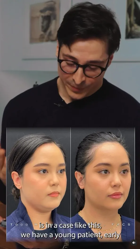 Hanna Buccal Fat Reduction IG 2