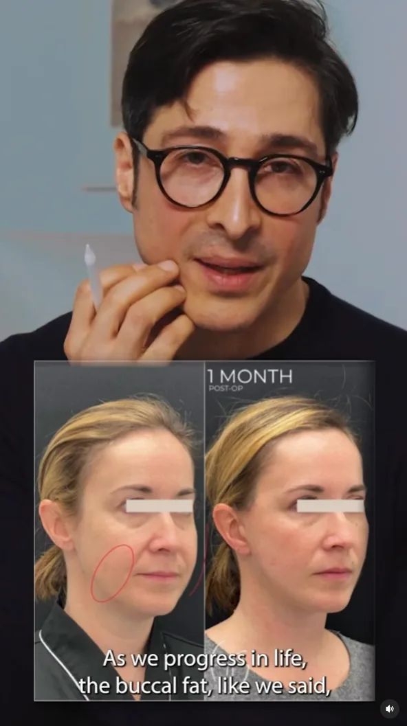 Hanna Buccal Fat Reduction IG 3