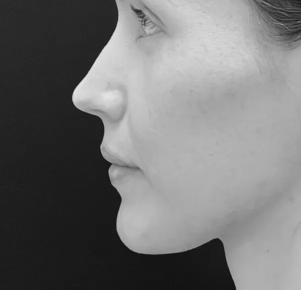 Rhinoplasty by Hanna Face and Jaw
