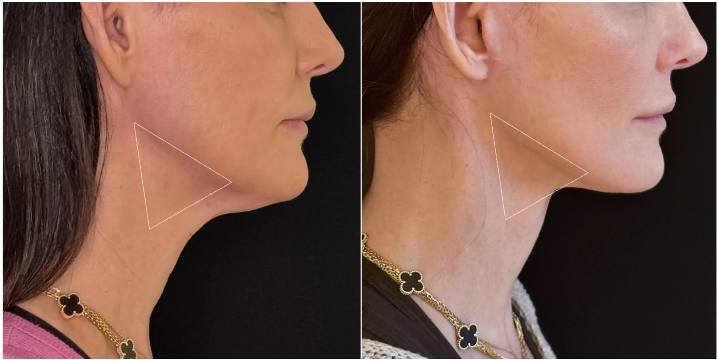 Submandibular Gland Reduction NYC Todd Hanna