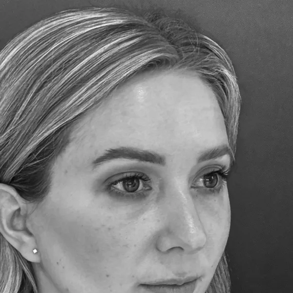 Brow Lift Dr Todd Hanna NYC