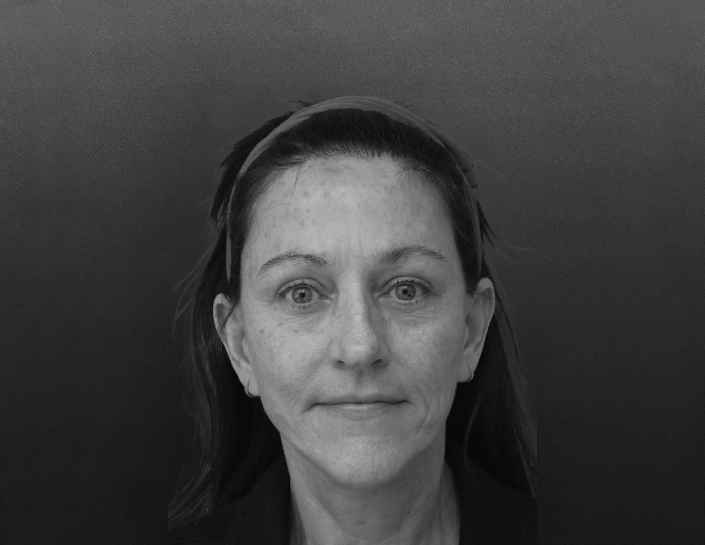 Brow Lift by Dr Todd Hanna NYC Plastic Surgeon