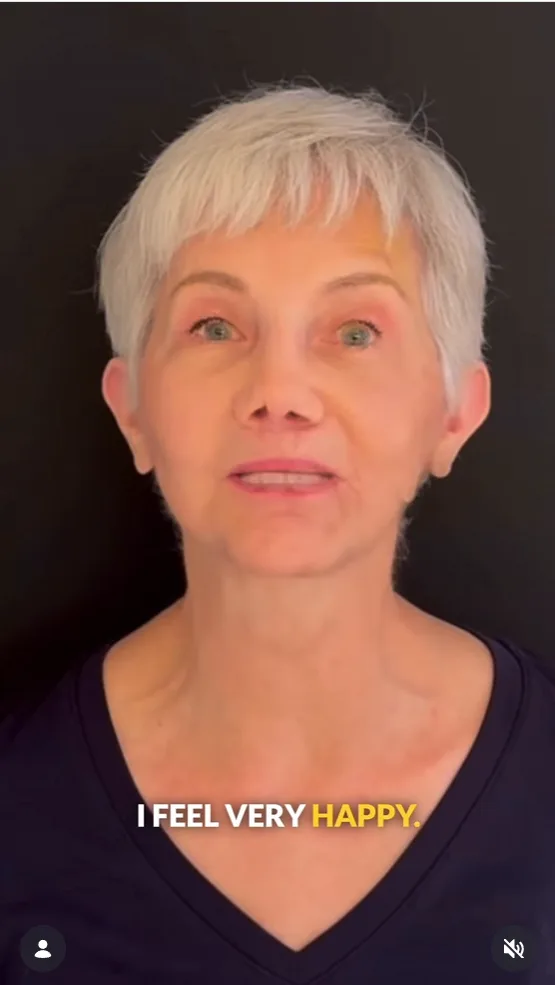 Face and Brow Lift by Dr Hanna