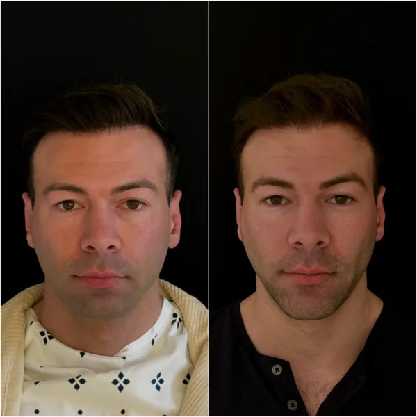 Chin Surgery Patient Result Dr Todd Hanna NYC 1