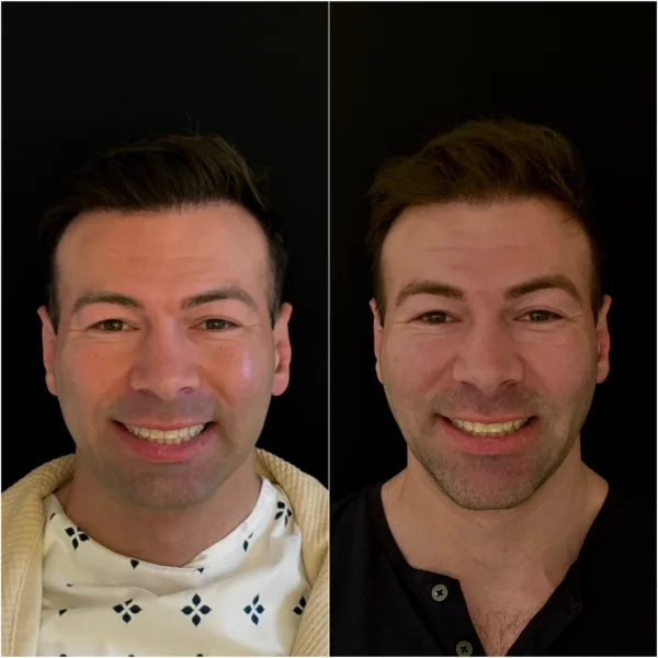 Chin Surgery Patient Result Dr Todd Hanna NYC 2