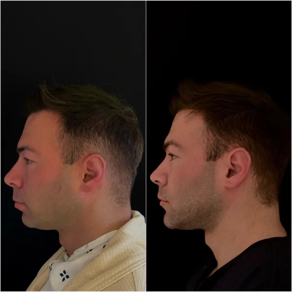 Chin Surgery Patient Result Dr Todd Hanna NYC 3