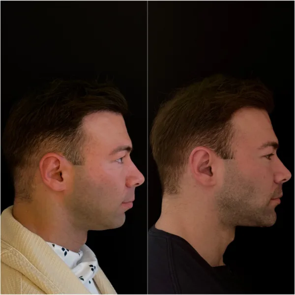 Chin Surgery Patient Result Dr Todd Hanna NYC 4