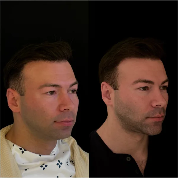 Chin Surgery Patient Result Dr Todd Hanna NYC 5