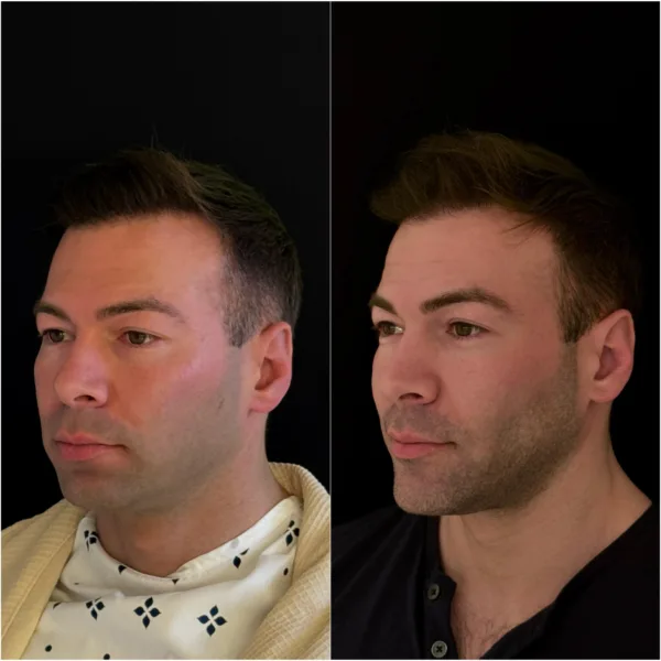 Chin Surgery Patient Result Dr Todd Hanna NYC 6