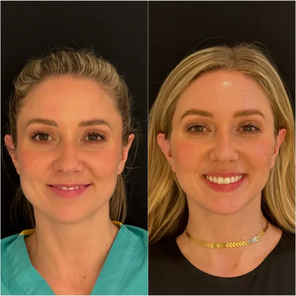 Dr Todd Hanna NYC Plastic Surgeon Patient Before and After - Chin Implant / Genioplasty (Custom) Dr Todd Hanna NYC Plastic Surgeon Patient Before and After