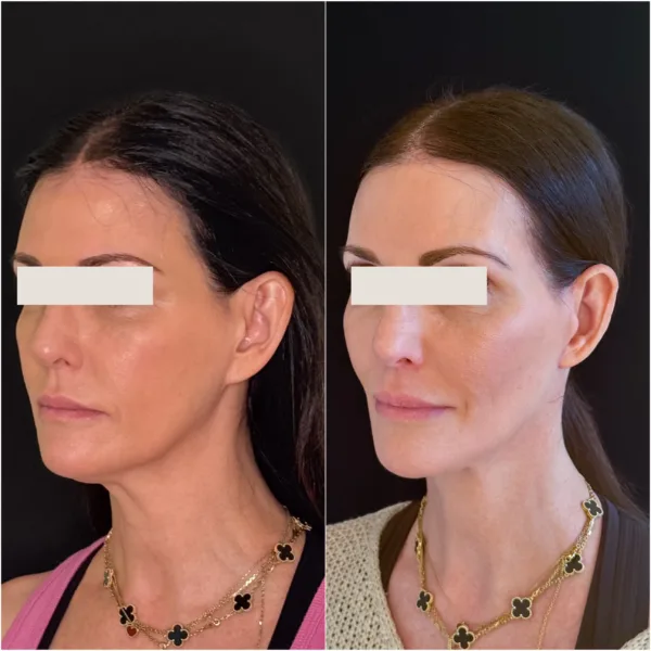 Hanna Face and Jaw NYC Results 10