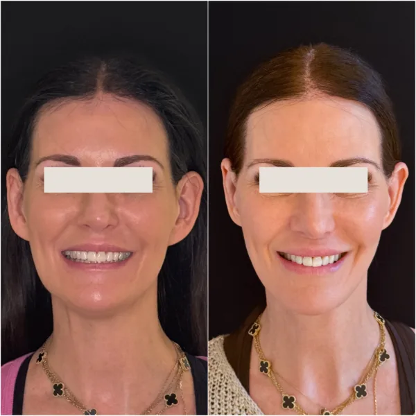 Hanna Face and Jaw NYC Results 2