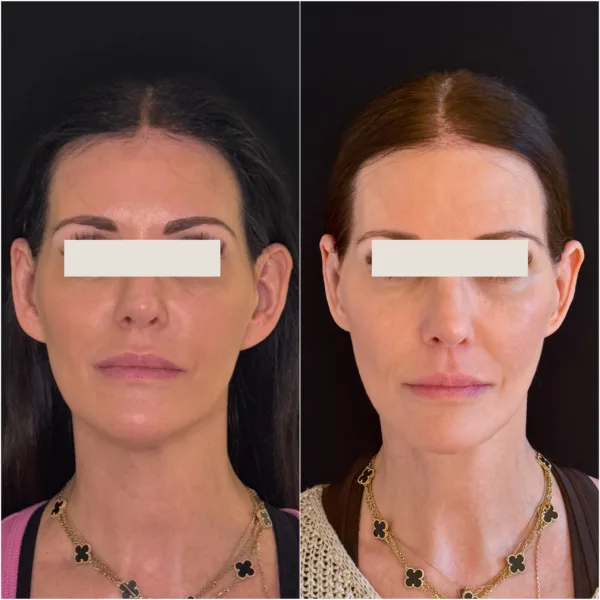 Hanna Face and Jaw NYC Results 3