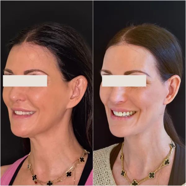 Hanna Face and Jaw NYC Results 4