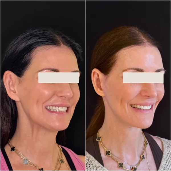 Hanna Face and Jaw NYC Results 5