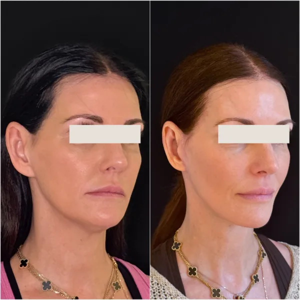 Hanna Face and Jaw NYC Results 6