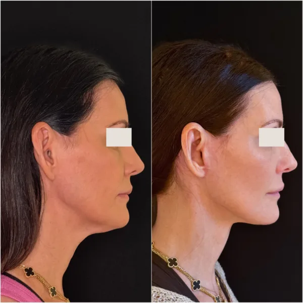 Hanna Face and Jaw NYC Results