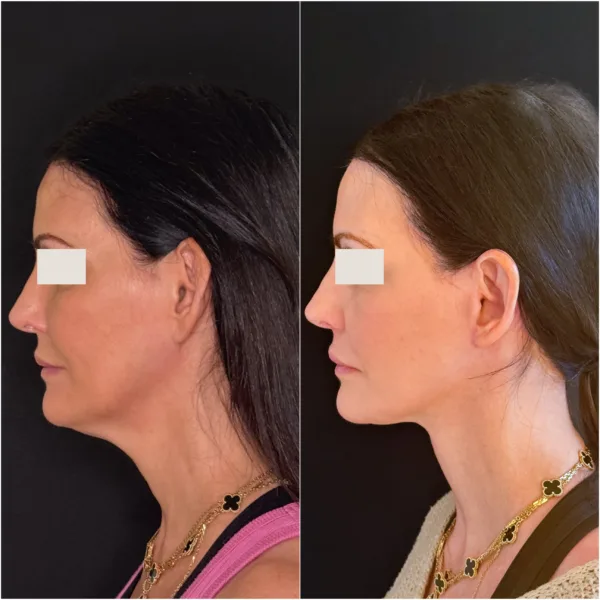 Hanna Face and Jaw NYC Results 7