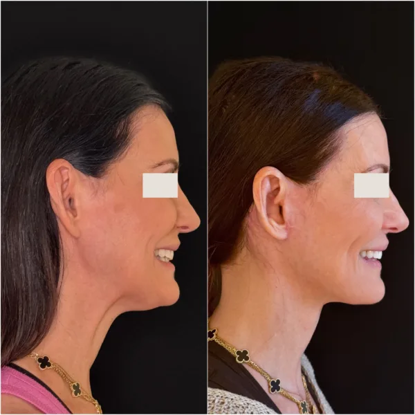 Hanna Face and Jaw NYC Results 8