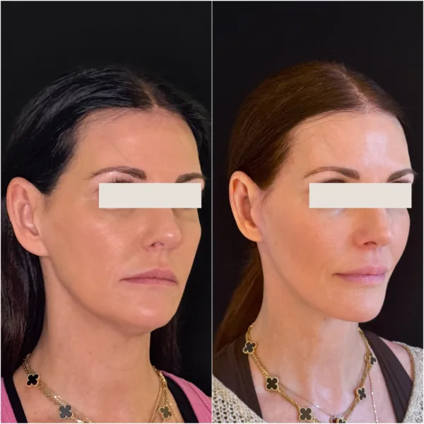 Hanna Face and Jaw NYC Results 9