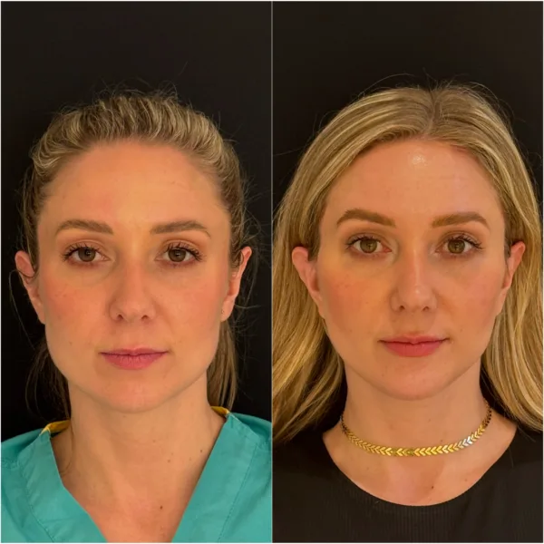 NYC Plastic Surgeon Dr Todd Hanna Patient Results - Chin Implant / Genioplasty (Custom) NYC Plastic Surgeon Dr Todd Hanna Patient Results