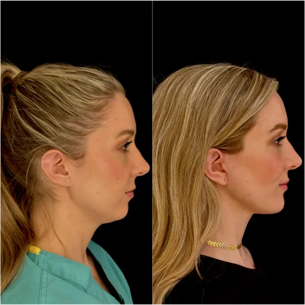 New York Plastic Surgeon Dr Todd Hanna Patient Before and After - Chin Implant / Genioplasty (Custom) New York Plastic Surgeon Dr Todd Hanna Patient Before and After