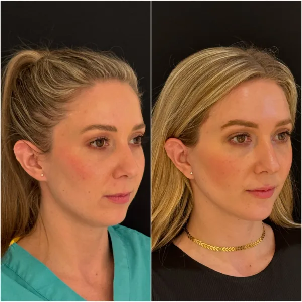 Patient Before and After Dr Todd Hanna NYC - Chin Implant / Genioplasty (Custom) Patient Before and After Dr Todd Hanna NYC