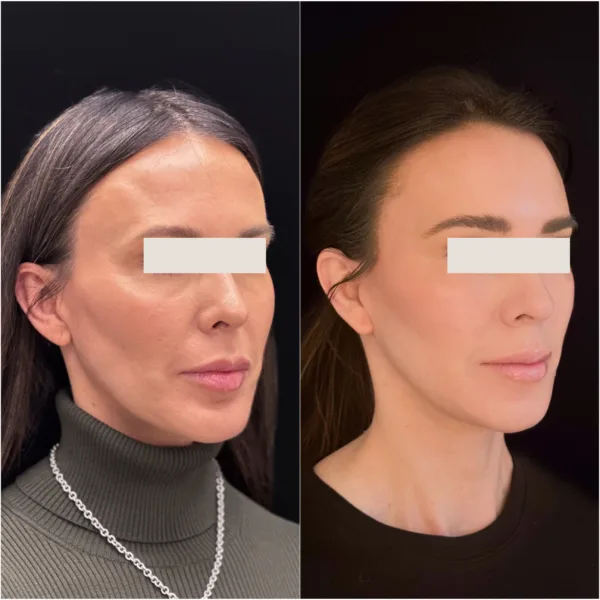 Todd Hanna Patient Results Before and After 2 - Chin Implant / Genioplasty (Custom) Todd Hanna Patient Results Before and After 2