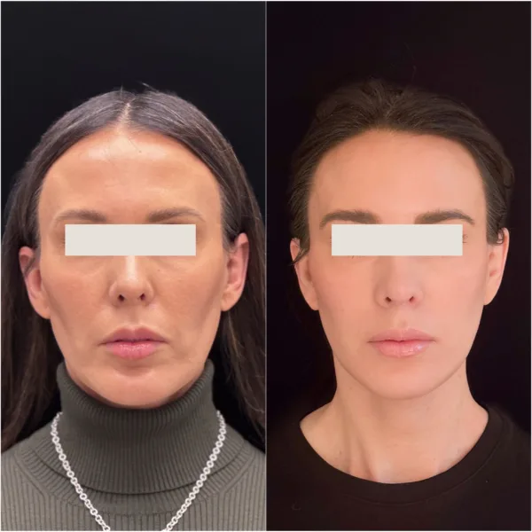 Todd Hanna Patient Results Before and After 3 - Chin Implant / Genioplasty (Custom) Todd Hanna Patient Results Before and After 3