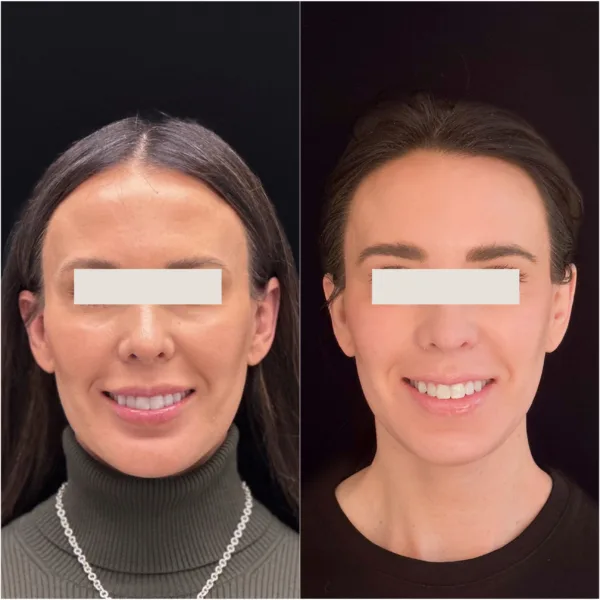 Todd Hanna Patient Results Before and After 4 - Chin Implant / Genioplasty (Custom) Todd Hanna Patient Results Before and After 4