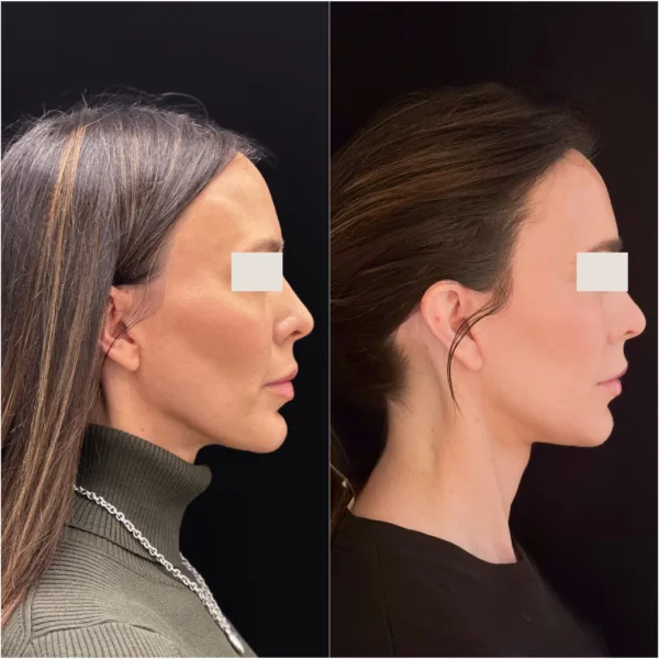 Todd Hanna Patient Results Before and After - Chin Implant / Genioplasty (Custom) Todd Hanna Patient Results Before and After