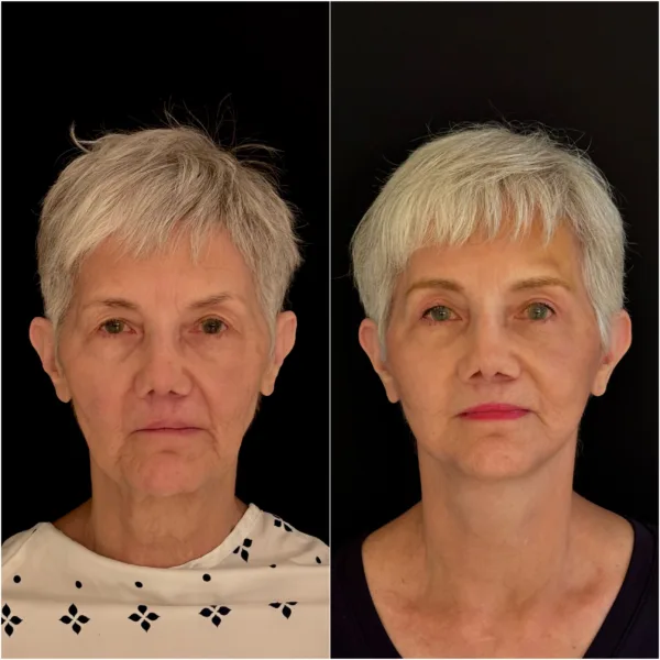 NYC Plastic Surgeon Todd Hanna Patient Before and After 1