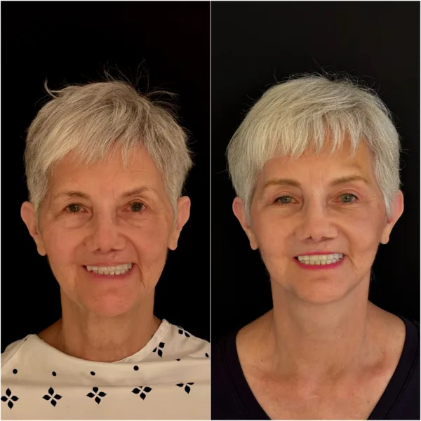 NYC Plastic Surgeon Todd Hanna Patient Before and After 2