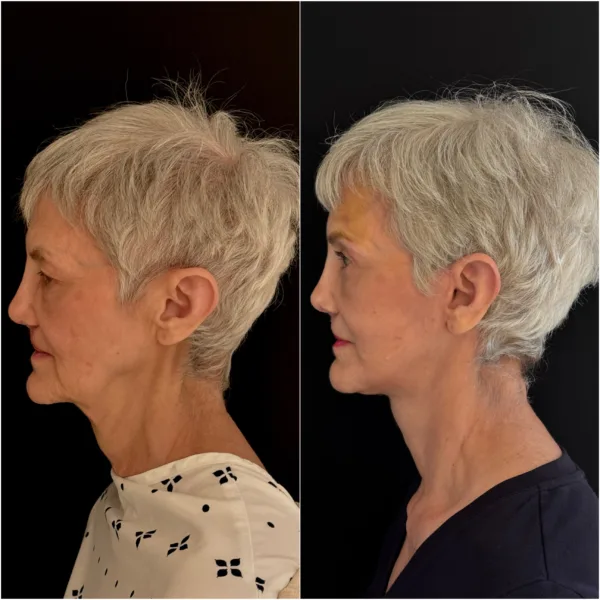 NYC Plastic Surgeon Todd Hanna Patient Before and After 3