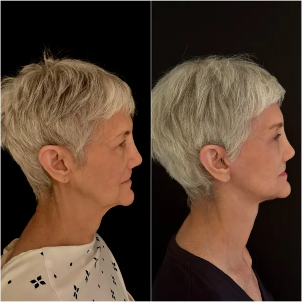 NYC Plastic Surgeon Todd Hanna Patient Before and After 4