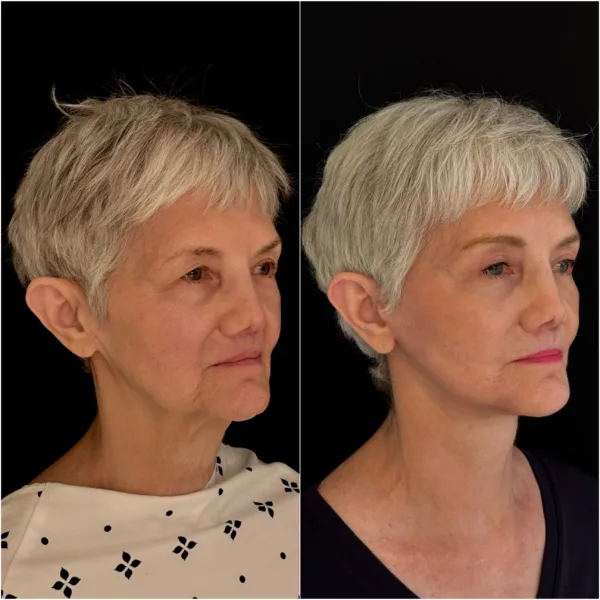 NYC Plastic Surgeon Todd Hanna Patient Before and After 5