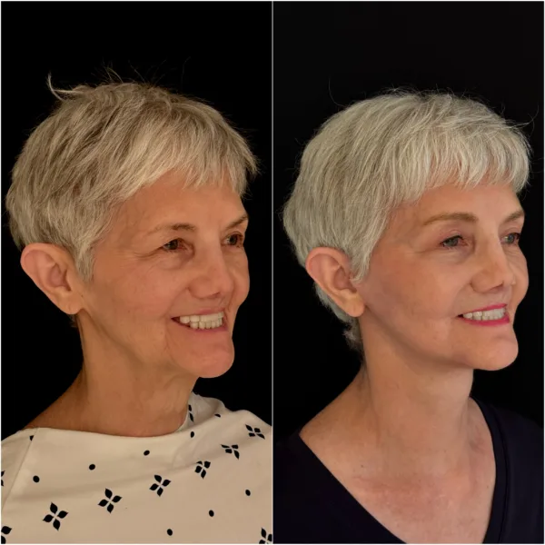NYC Plastic Surgeon Todd Hanna Patient Before and After 6