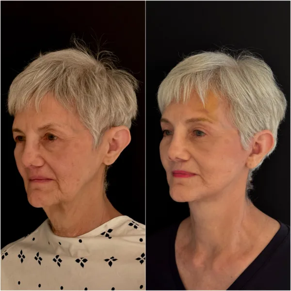 NYC Plastic Surgeon Todd Hanna Patient Before and After 7