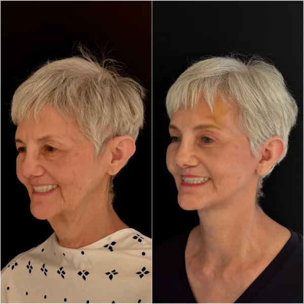 NYC Plastic Surgeon Todd Hanna Patient Before and After 8