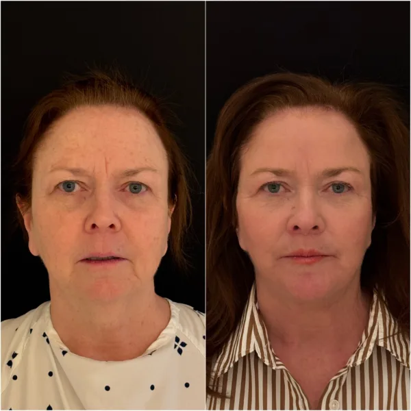 Todd Hanna NYC Plastic Surgeon Patient Results 1