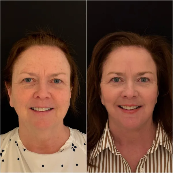 Todd Hanna NYC Plastic Surgeon Patient Results 2