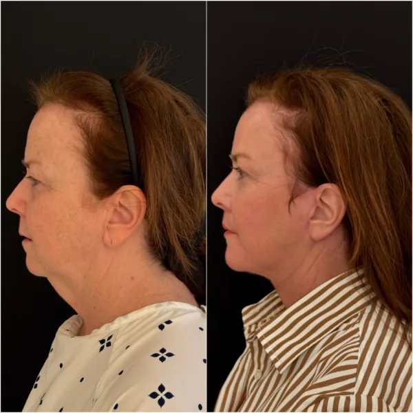 Todd Hanna NYC Plastic Surgeon Patient Results 3