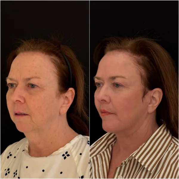 Todd Hanna NYC Plastic Surgeon Patient Results 4