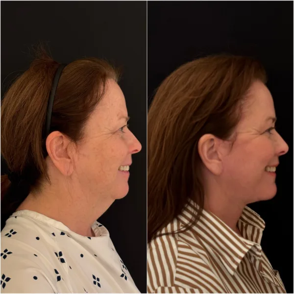 Todd Hanna NYC Plastic Surgeon Patient Results 5