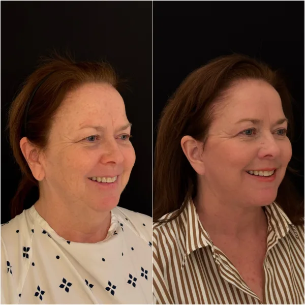 Todd Hanna NYC Plastic Surgeon Patient Results 6
