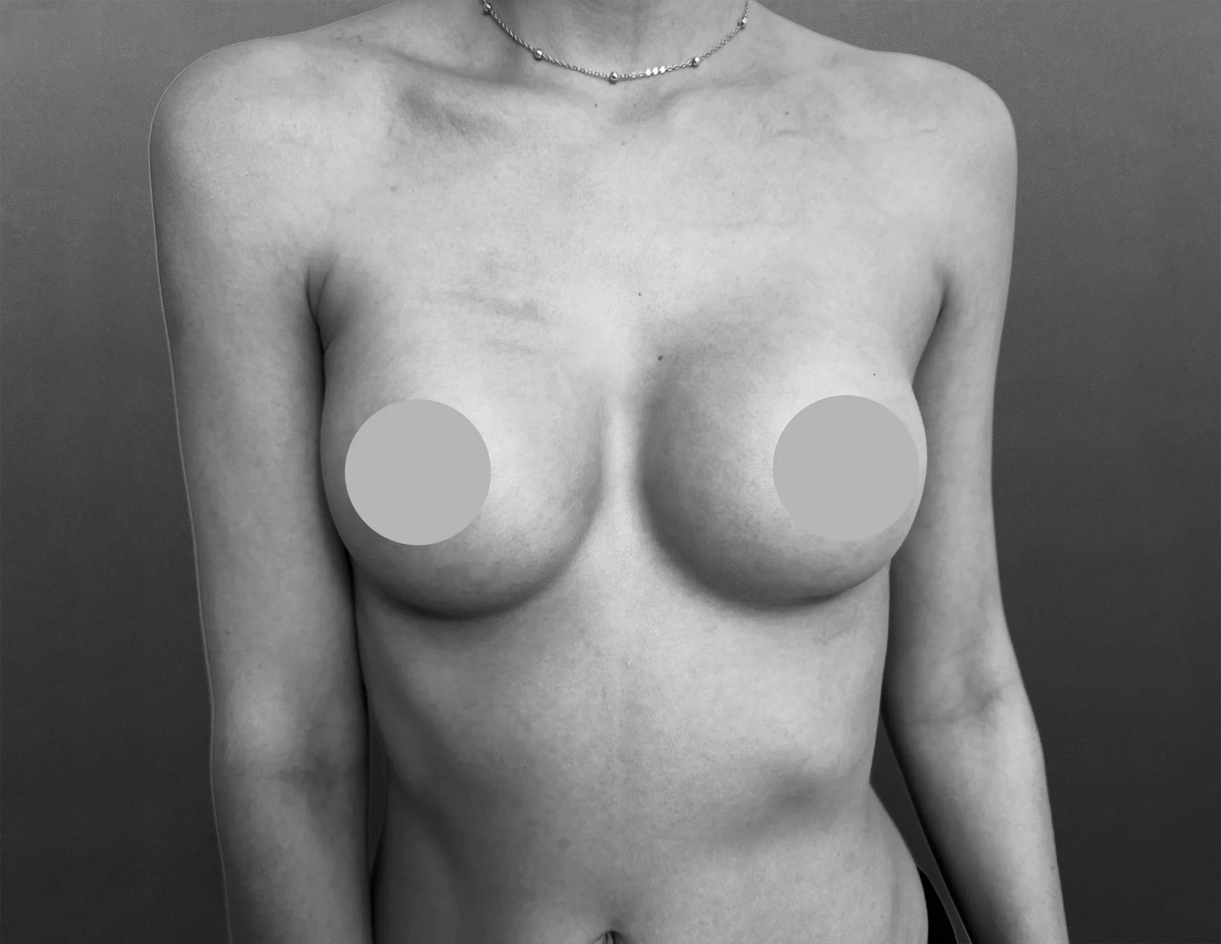 Medical Procedure Breast Augmentation After Photo Dr Natalie Plana - Breast Augmentation Breast augmentation result, frontal view, two years post-op, by Dr. Natalie Plana