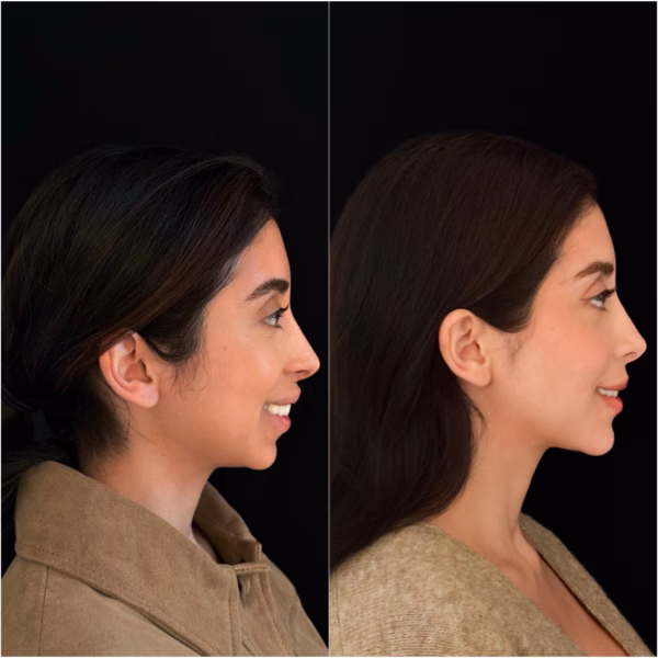 Butterfly Genioplasty Dr Todd Hanna 10