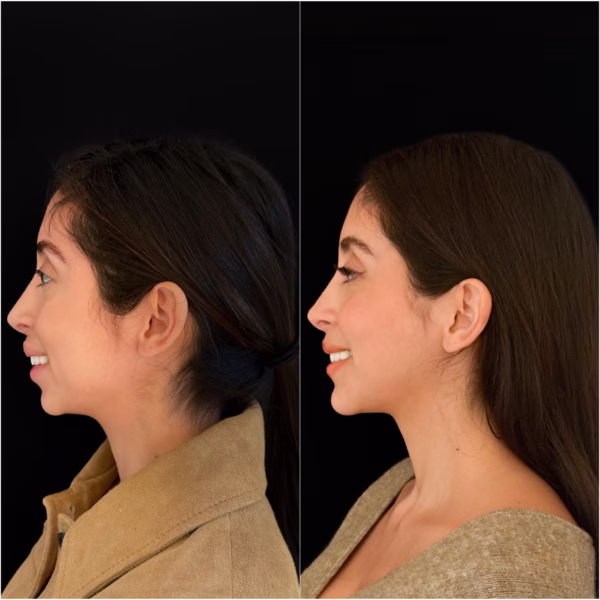 Butterfly Genioplasty Dr Todd Hanna 2