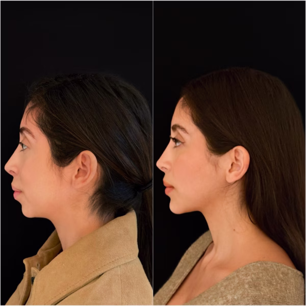 Butterfly Genioplasty Dr Todd Hanna